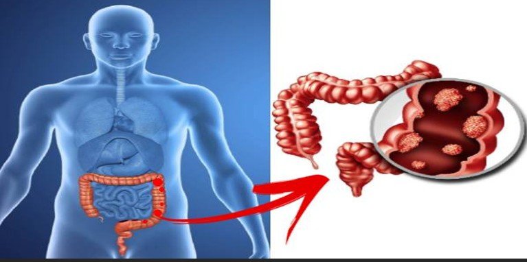 Colorectal cancer on the rise among young people