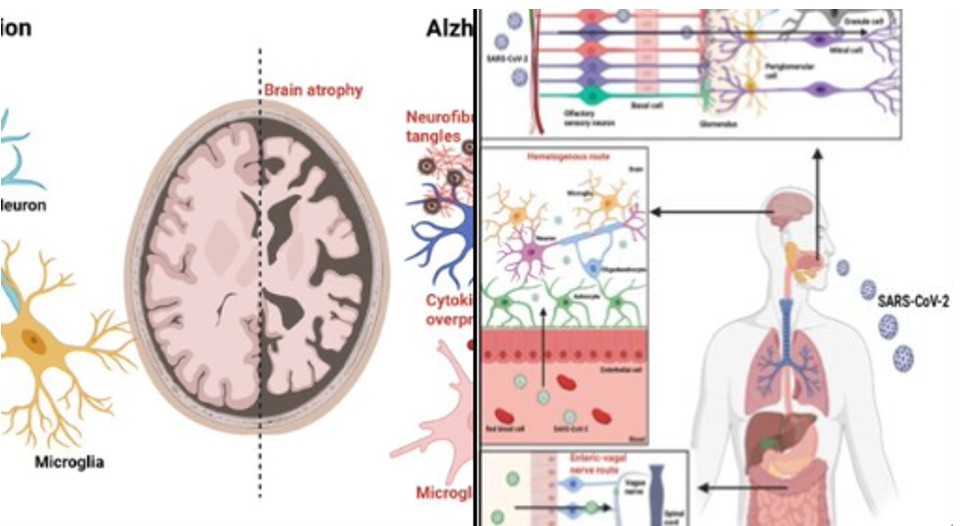 Covid-19 linked to rise in Alzheimer's risk