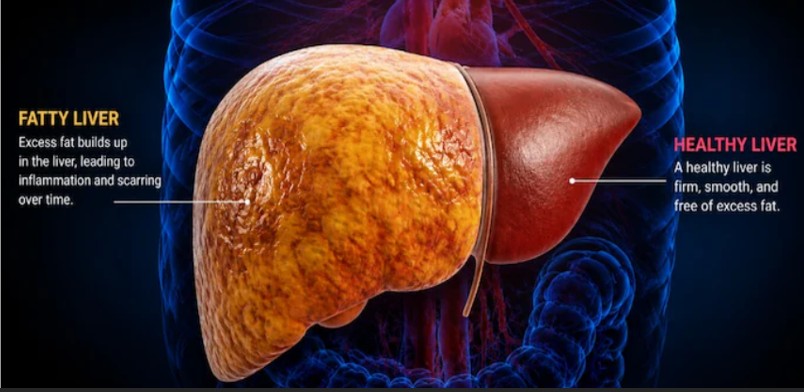 Fatty liver affects 1 in 3 adults globally
