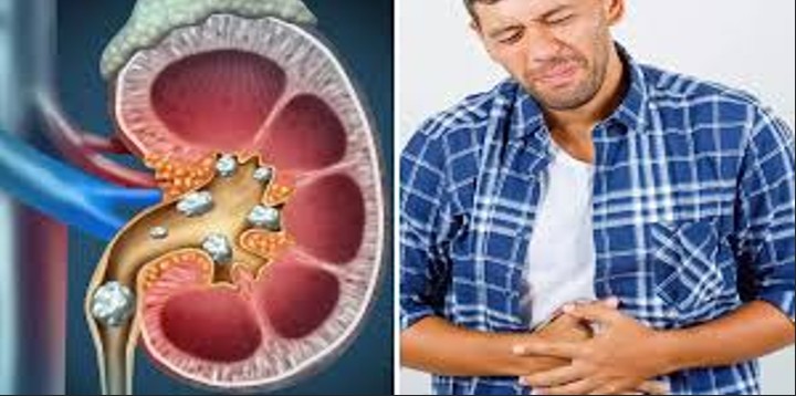 Kidney Stone Surgeries Delayed at National Hospital of Sri Lanka