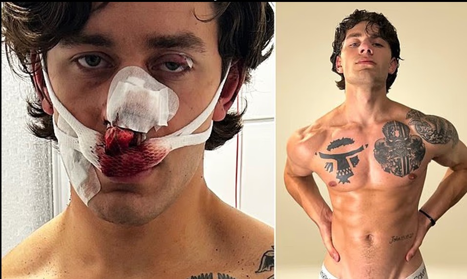 New York Model attacked while protecting two women from knifeman on vacation in Germany